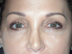 Female Eyelid Surgery