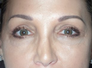 Patient 13 - After View 