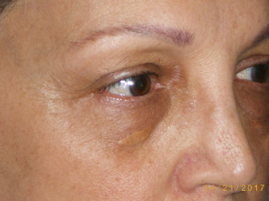 Female Eyelid Surgery