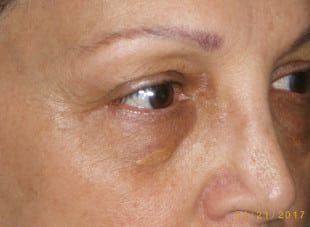 Patient 13 - Before View 