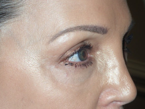 Female Eyelid Surgery