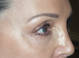 Patient 13 - After View 