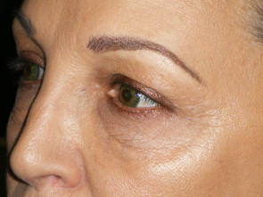 Female Eyelid Surgery