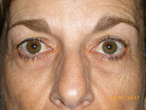 Female Eyelid Surgery