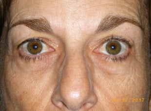Patient 19 - Before View 