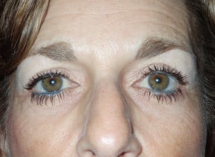 Patient 19 - After View 