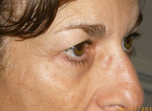 Patient 19 - Before View 