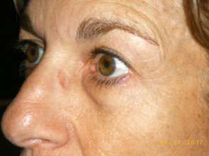 Female Eyelid Surgery