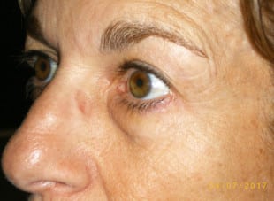Patient 19 - Before View 