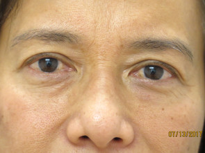 Female Eyelid Surgery