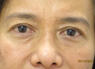 Patient 26 - Before View 