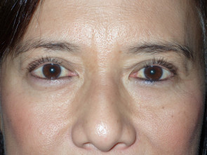 Female Eyelid Surgery