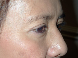 Female Eyelid Surgery