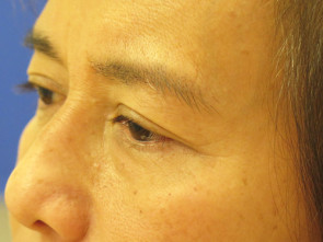 Female Eyelid Surgery