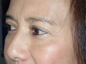 Female Eyelid Surgery