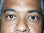 Male Eyelid Surgery