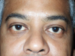 Male Eyelid Surgery