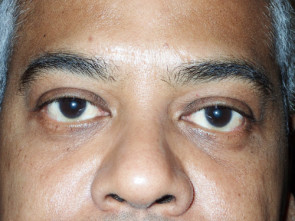 Male Eyelid Surgery