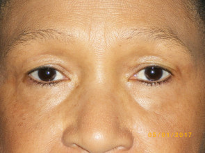 Female Eyelid Surgery