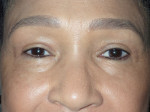 Female Eyelid Surgery