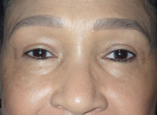 Patient 32 - After View 