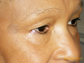 Female Eyelid Surgery