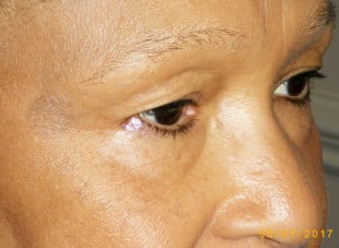 Patient 32 - Before View 
