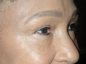 Female Eyelid Surgery