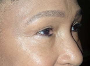 Patient 32 - After View 