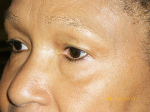 Female Eyelid Surgery