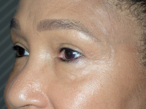 Female Eyelid Surgery