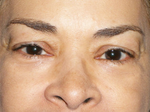 Female Eyelid Surgery