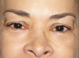 Patient 44 - Before View 