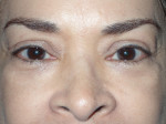 Female Eyelid Surgery