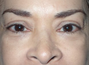 Patient 44 - After View 