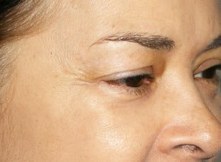 Patient 44 - Before View 