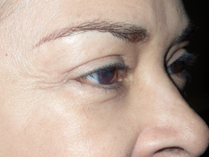 Female Eyelid Surgery