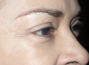 Patient 44 - After View 