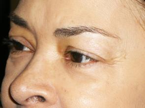 Female Eyelid Surgery