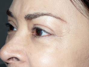 Female Eyelid Surgery