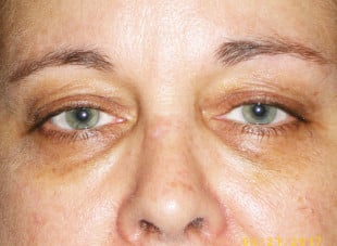 Patient 48 - Before View 