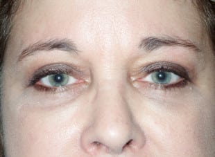 Patient 48 - After View 