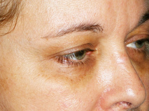 Female Eyelid Surgery