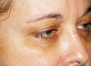 Patient 48 - Before View 