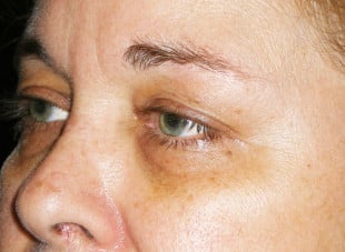 Patient 48 - Before View 