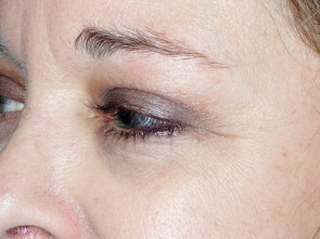 Female Eyelid Surgery