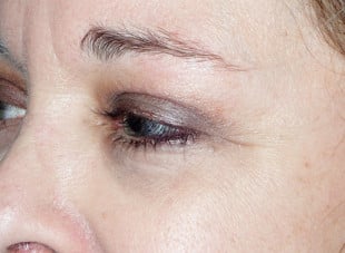 Patient 48 - After View 