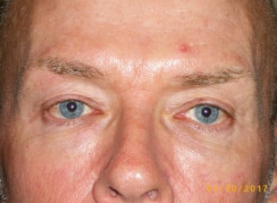 Patient 20 - Before View 
