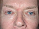 Male Eyelid Surgery