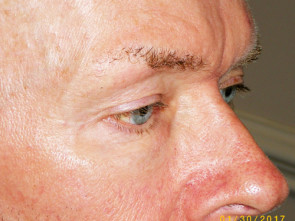 Male Eyelid Surgery